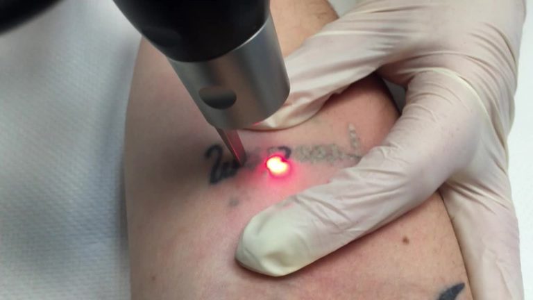 tatto removal